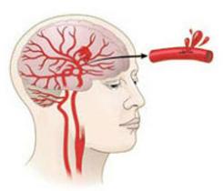 2014天坛国际脑血管病会议